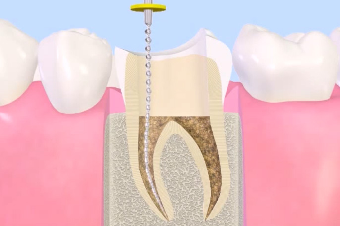 歯の根の治療
